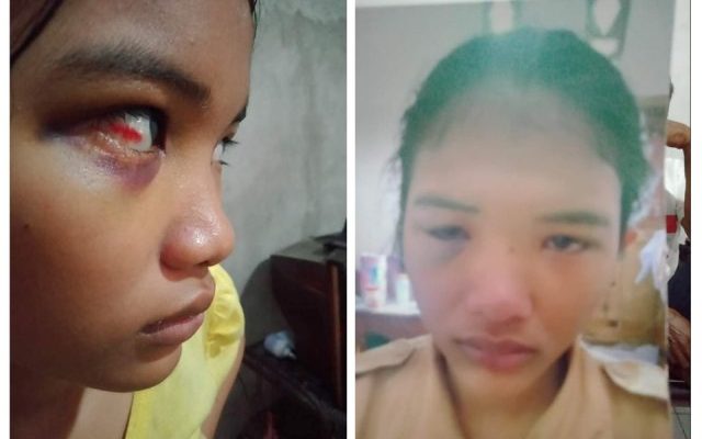 Wajah lebam dan mata memerah didapatkan Betaria di SMA Negeri 7 Sarolangun, Rabu (04/09/2019). Hari ini, Rabu (11/09/2019) Beta melapor ke DP3A Sarolangun.